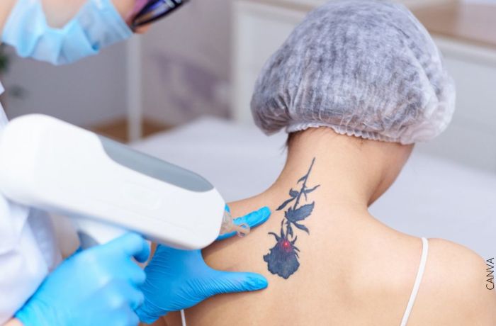 Ako odstrániť tetovanie doma - môžete to naozaj urobiť?